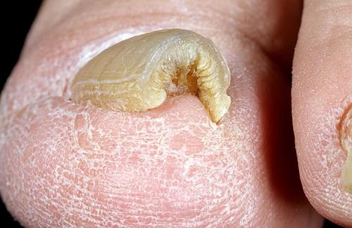 Онихолизин аналог. Онихогрифоз