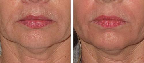 Лазер для лица в косметологии паломар. Лазер Паломар (Рalomar) – комфортное лазерное омоложение