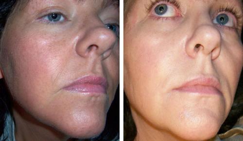 Химический пилинг с трихлоруксусной кислотой. ТСА пилинг и все, что о нем нужно знать