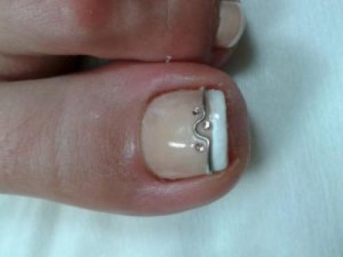 Коррекция вросшего ногтей в домашних условиях. Лечение вросшего ногтя в домашних условиях