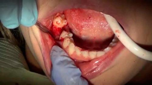 Противоотечные препараты для лица после удаления зуба. Когда отек – повод для визита к врачу