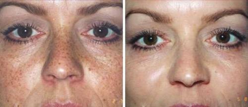 Роз де Мер от растяжек. Отзывы с фотографиями до и после процедур пилинга Rose De Mer