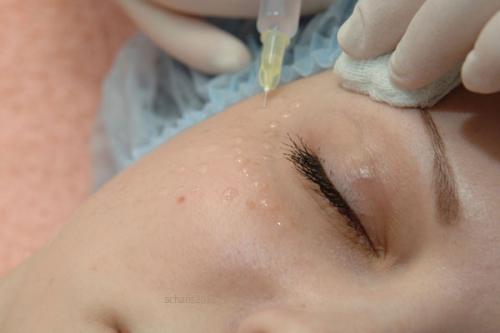 Лазерное устройство для омоложения кожи вокруг глаз. Инъекционные технологии омоложения кожи вокруг глаз