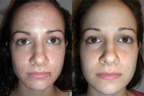 Роз де Мер от растяжек. Отзывы с фотографиями до и после процедур пилинга Rose De Mer