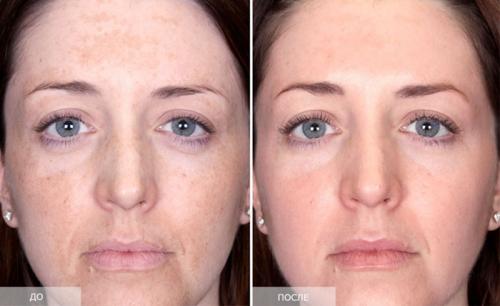 Гликолевая кислота крем для лица. Как работает крем с гликолевой кислотой?