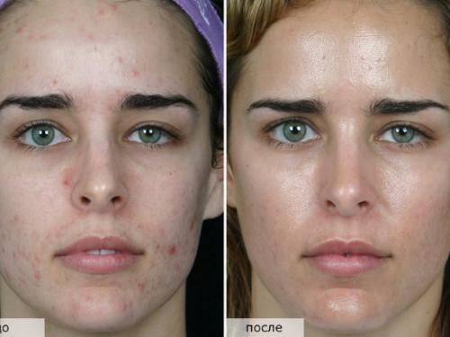 Ультразвуковая чистка лица. Каких результатов следует ждать от процедуры