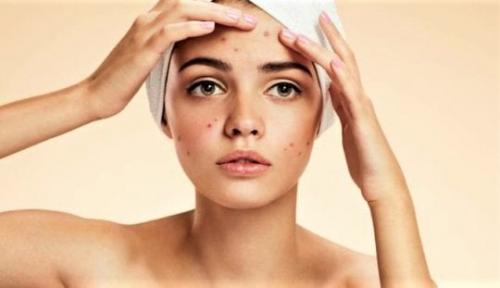 Уход за кожей склонной к угрям. Признаки