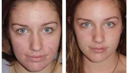 Белара от прыщей на лице помогает. Избавление от прыщей с помощью препарата «Белара»