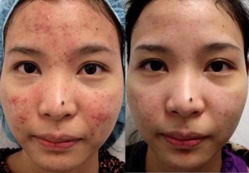 Алмазный пилинг лица – что это такое и с чем его едят? Рассказывают косметологи