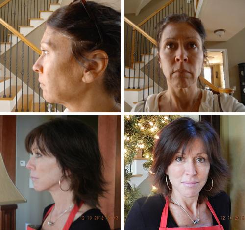 Оцените результат круговой подтяжки лица в фото до и после операции