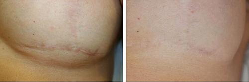 Лазер для лица в косметологии Паломар. Лазер Паломар (Рalomar) – комфортное лазерное омоложение