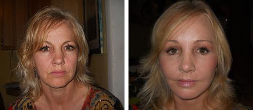 Оцените результат круговой подтяжки лица в фото до и после операции