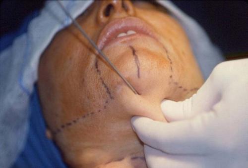 Какими процедурами можно подтянуть овал лица. Лучшие способы подтяжки овала лица и контура