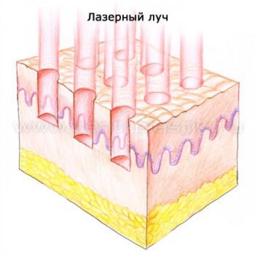 Лазерное омоложение уход после. Преимущества лазерного омоложения лица