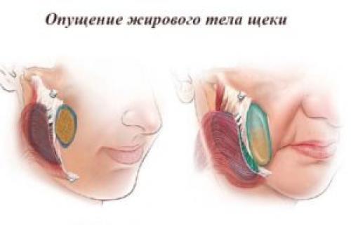 Как убрать брыли на лице методы и процедур. Убираем брыли и подтягиваем овал лица