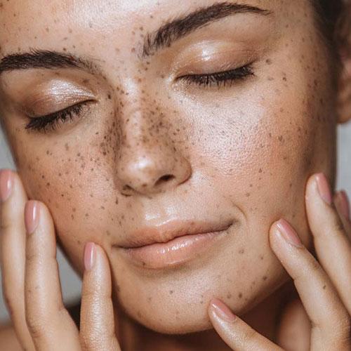 Уход за жирной кожей лица с угрями. Как определить свой тип