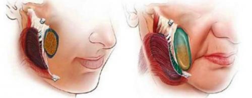 Как убрать брыли на лице в 50 лет. Признаки старения