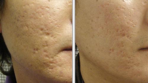 Лазерное омоложение уход после. Преимущества лазерного омоложения лица