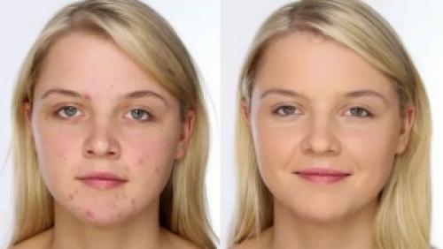 Мазь от прыщей Бензилбензоат. Можно ли наносить на кожу Бензилбензоат от прыщей?