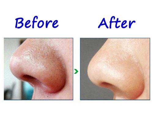 Алмазный пилинг лица – что это такое и с чем его едят? Рассказывают косметологи