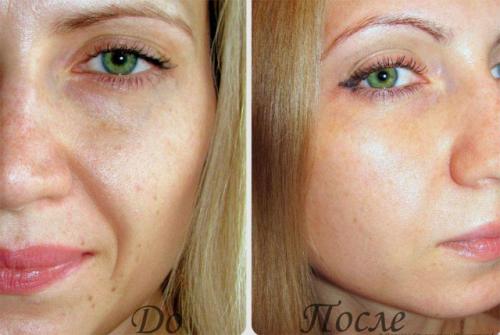 Микротоки, что это такое в косметологии. Микротоковая терапия лица