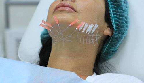 Подтяжка лица до и после. Техника проведения