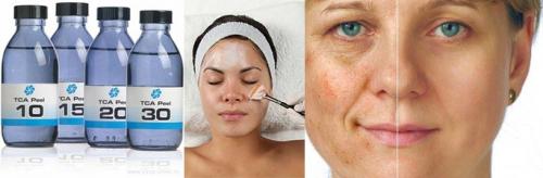 Пилинг трихлоруксусной кислотой в домашних условиях. Свойства трихлоруксусной кислоты