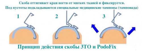 Коррекция вросшего ногтя титановой нитью. Реальные отзывы о Титановых нитях на ногти