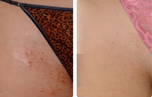 После шугаринга вросли волосы на ногах. Отзывы о том, как бороться с вросшими волосами после шугаринга