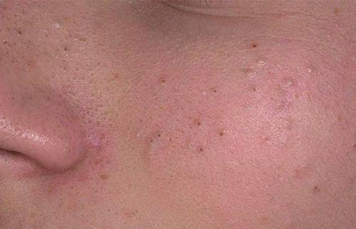 Как избавиться от широких пор на щеках. Причина расширения пор