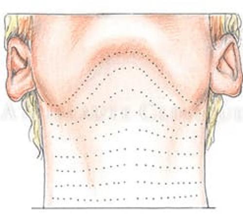 Мезоботокс разведение препарата. Ботокс и мезоботокс – в чём отличие?