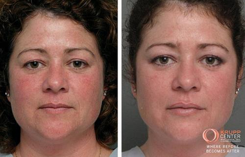 Химический пилинг с трихлоруксусной кислотой. ТСА пилинг и все, что о нем нужно знать