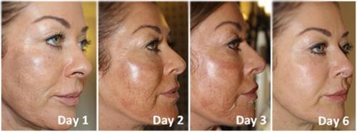 Пилинг трихлоруксусной кислотой в домашних условиях. Свойства трихлоруксусной кислоты