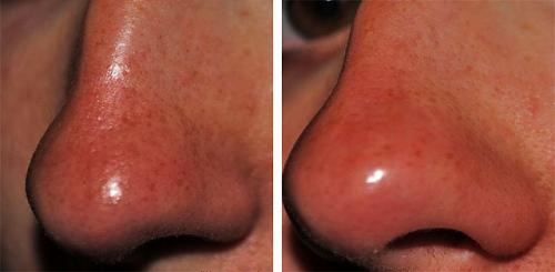 Очень расширены поры на всем лице причины и лечение. Как избавиться от расширенных пор на лице