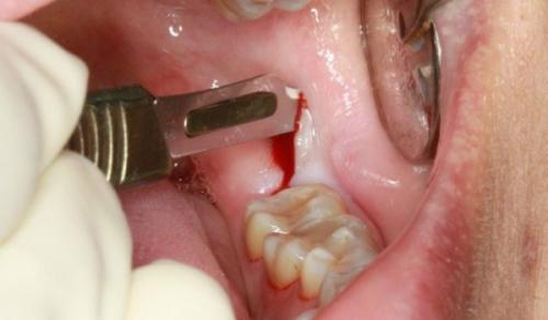 Противоотечные препараты для лица после удаления зуба. Когда отек – повод для визита к врачу