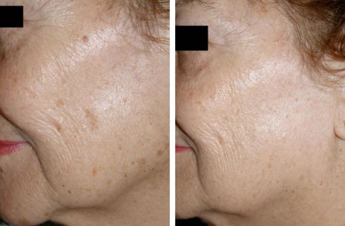 Лазер для лица в косметологии Паломар. Лазер Паломар (Рalomar) – комфортное лазерное омоложение