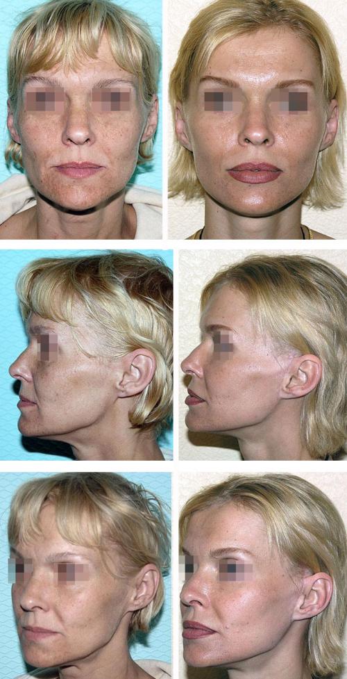 Оцените результат круговой подтяжки лица в фото до и после операции