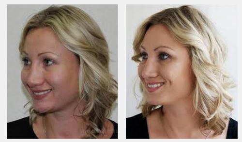 До и после операции ямочки на щеках. Как проходит оперативное вмешательство