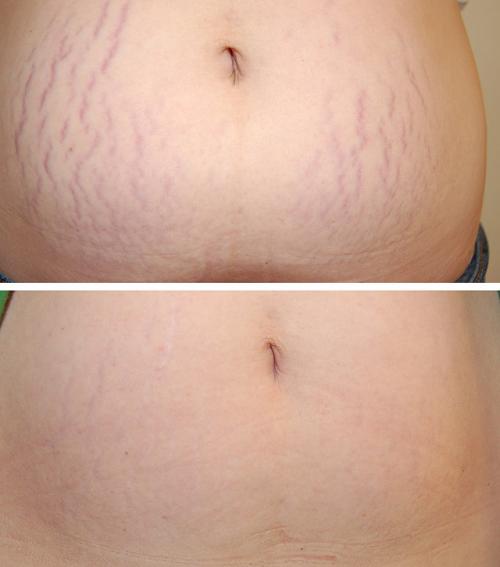 Лазер для лица в косметологии паломар. Лазер Паломар (Рalomar) – комфортное лазерное омоложение