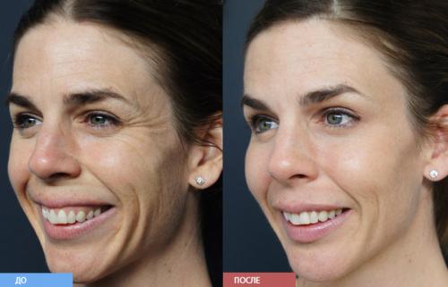 Сколько держится мезоботокс. Что такое мезоботокс и с чем его едят