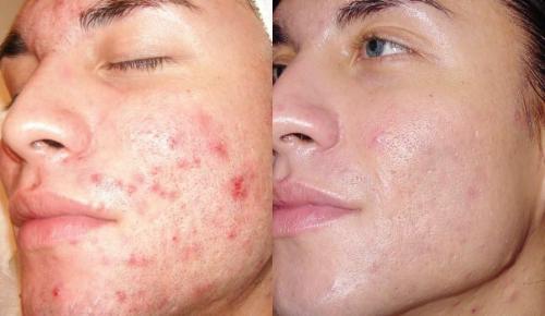 Алмазный пилинг лица – что это такое и с чем его едят? Рассказывают косметологи