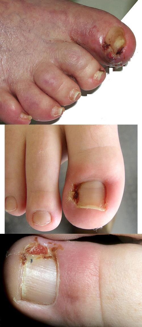 Пластины для коррекции вросшего ногтя в домашних условиях. Вросший ноготь: как лечить в домашних условиях