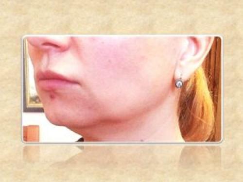 Как убрать брыли на лице методы и процедур. Убираем брыли и подтягиваем овал лица