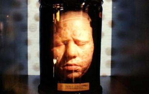 Парень использует пинцет, чтобы вытащить самый длинный вросший волос в мире из своего лица