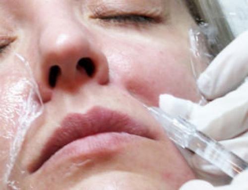 Что лучше колоть в носогубные складки. Как проходит процедура