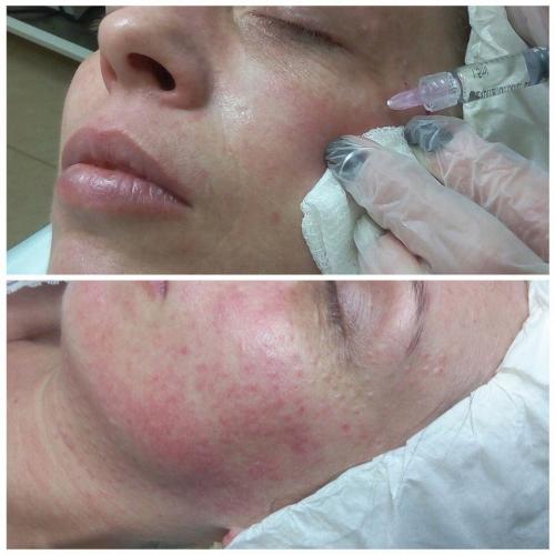 Процедуры для подтяжки овала лица. Методы подтяжки овала лица