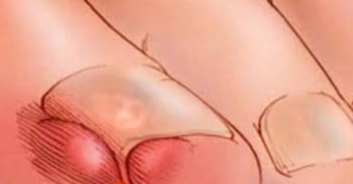 Больно ли удалять вросший ноготь на ноге