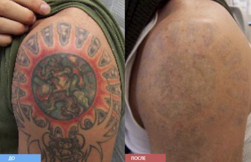 Неодимовый лазер в косметологии противопоказания. Что такое неодимовый лазер