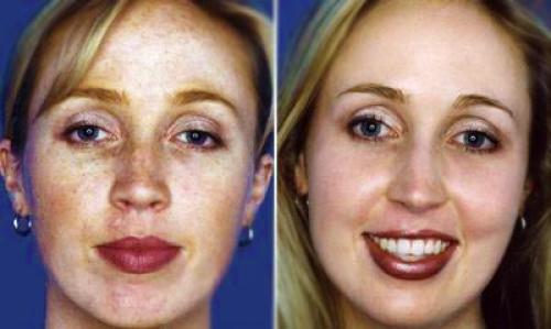 Пилинг трихлоруксусной кислотой в домашних условиях. Свойства трихлоруксусной кислоты