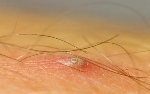 Как избавиться от вросших волос в зоне бикини после эпиляции. Что нельзя делать, если образовалась шишка